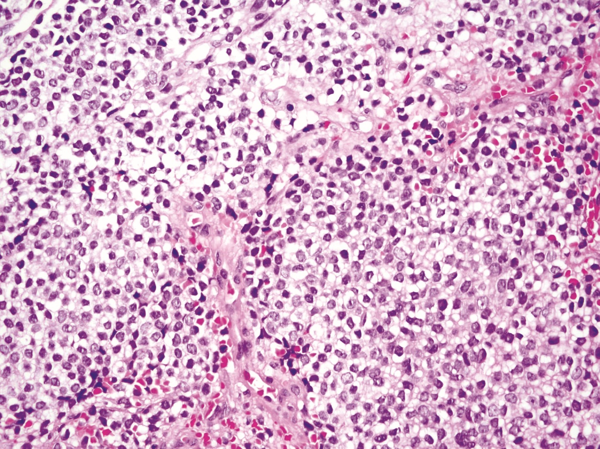 Sarcoma edwing